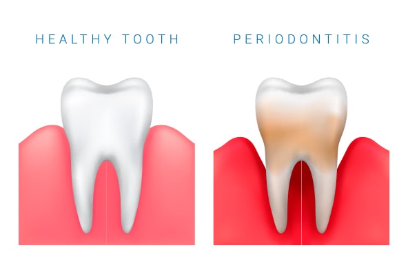 Periodontologia - efekty